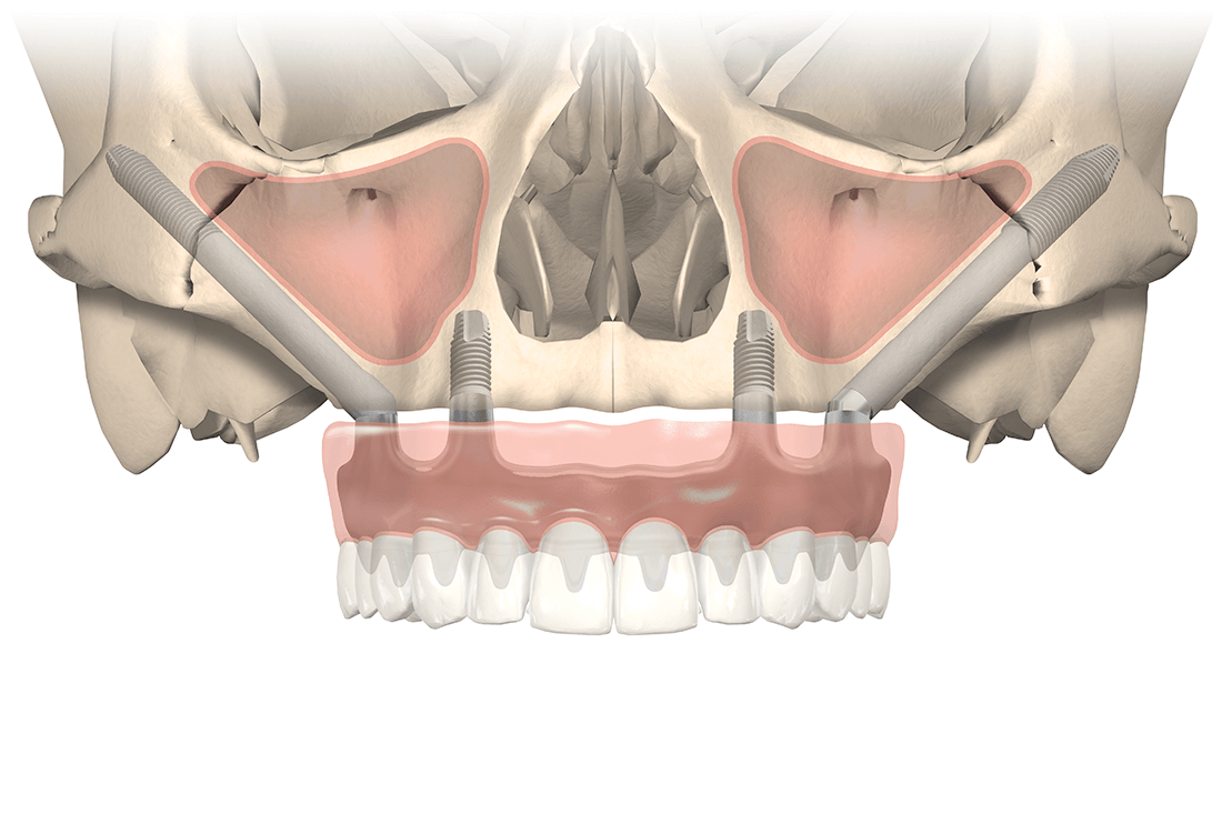 Mund-Kiefer-Gesichtschirurgie-Pforzheim-Zygoma-Implantat